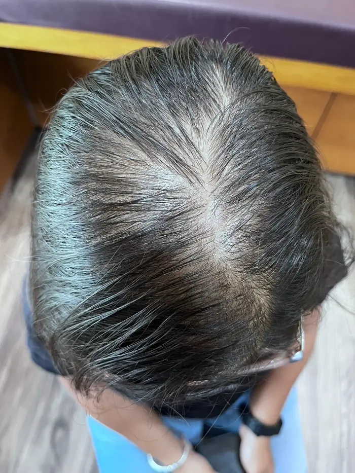 Female Pattern Baldness case 2 before treatment